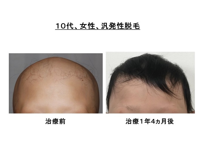 円形脱毛症　病院